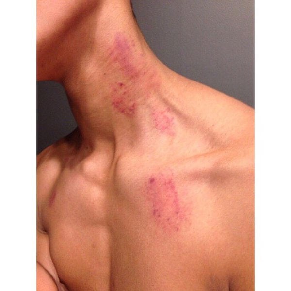 4. Причиной смерти стал инсульт. Доктора, проводившие вскрытие, утверждают, что удар был спровоцирован засосами на теле Гонсалеса.