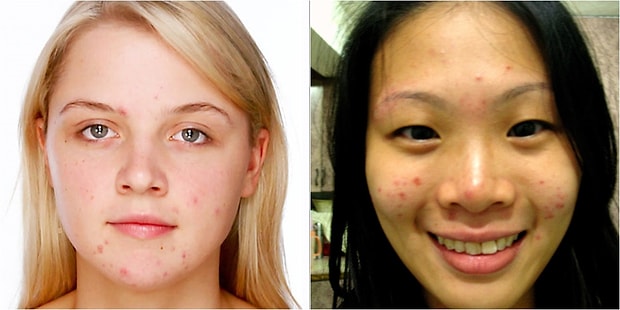 Hayrete Dusuren Bir Teori Daha Sivilceleriniz Size Bir Sey Soylemek Istiyor Olabilir Mi