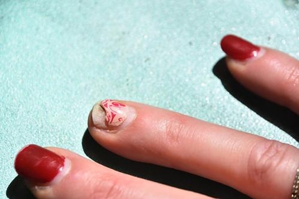 10. Опухлость пальцев и слоение ногтей