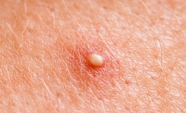 3. Передается ли половым путем фурункул?