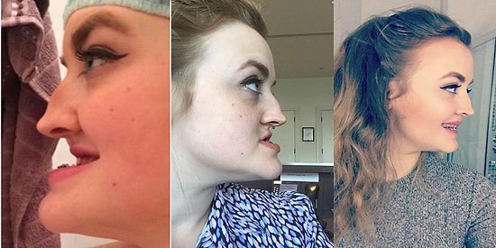 Çenesi ve Dişlerinin Görünümü Nedeniyle Hayatı Boyunca Zorbalığa Maruz Kalıp Ameliyat Olan Kadın