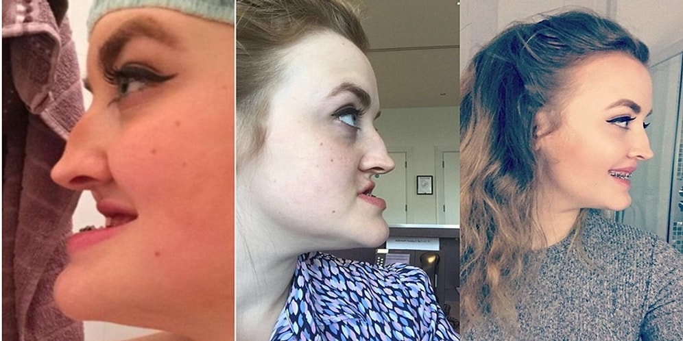 Çenesi ve Dişlerinin Görünümü Nedeniyle Hayatı Boyunca Zorbalığa Maruz Kalıp Ameliyat Olan Kadın