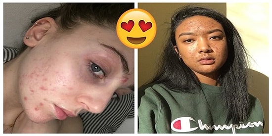 Kadınların Kendilerini Sivilceleriyle Birlikte Sevmeleri İçin Harika Bir Kampanya Başlatan Model!