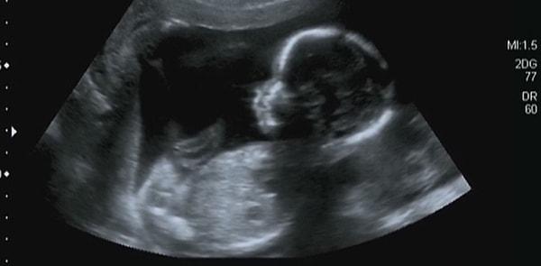 6 haftalik bebek ultrasonda gorulur mu bebek battaniyesi