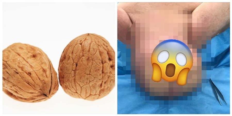 Penis Kanseri Belirtileri Peniste Siskinlik Kanser Belirtisi Mi