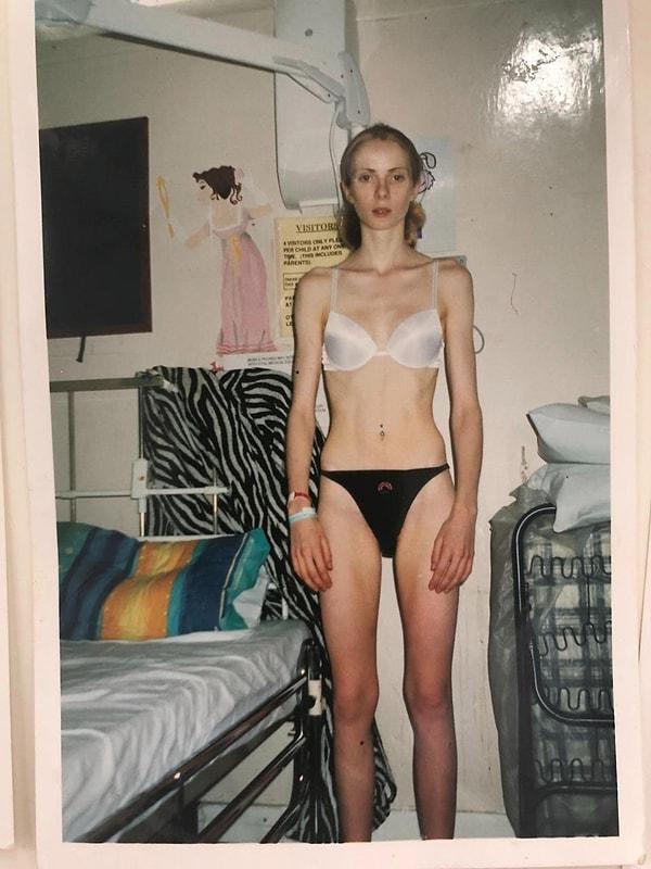 Olivia Cooper gençken anoreksiya hastalığına sahipti.
