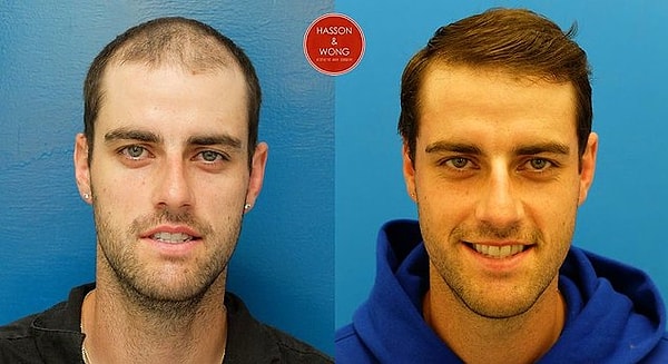 Пересадка волос!