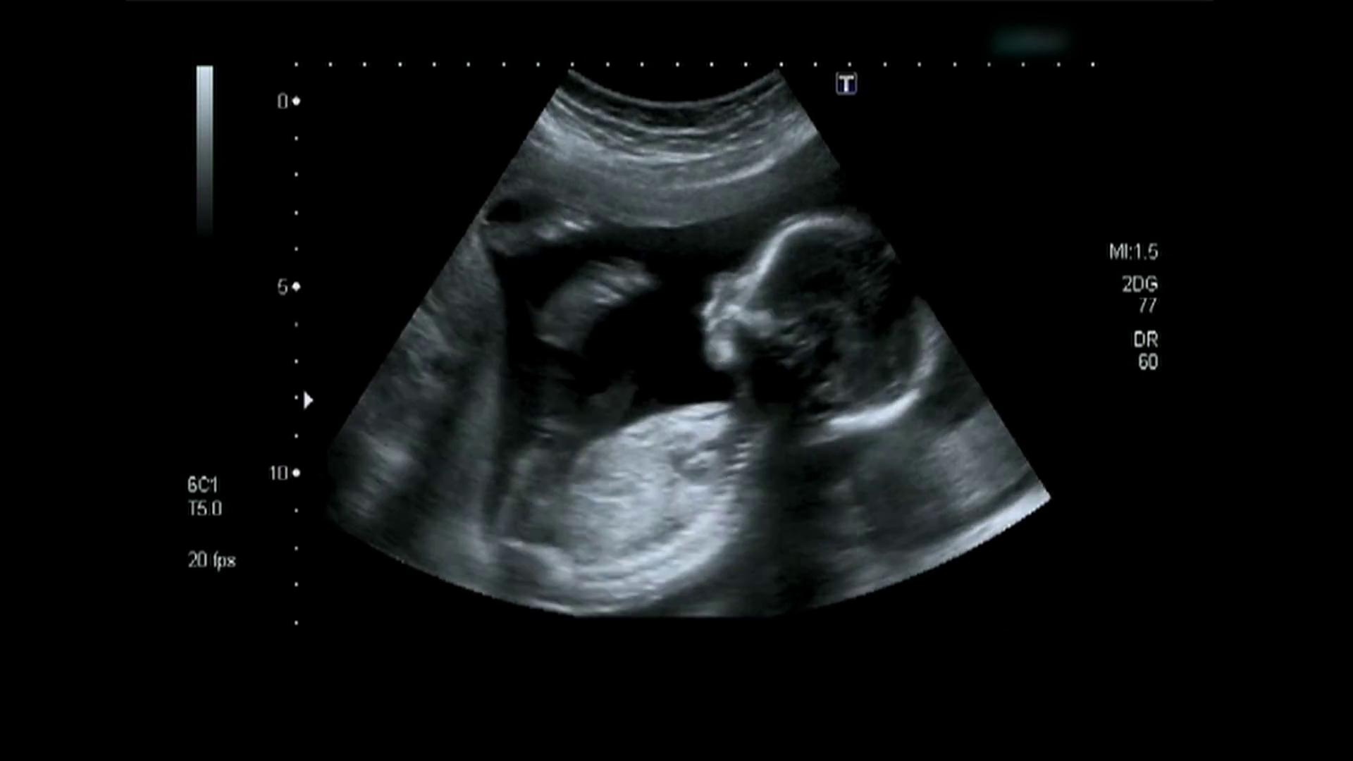 Ребенок в животе 2 неделя. Снимок УЗИ ребенка 20 недель беременности. УЗИ плода на 24 неделе беременности. Эмбрион на 24 неделе беременности УЗИ. Малыш на 20 неделе беременности в животе фото УЗИ.