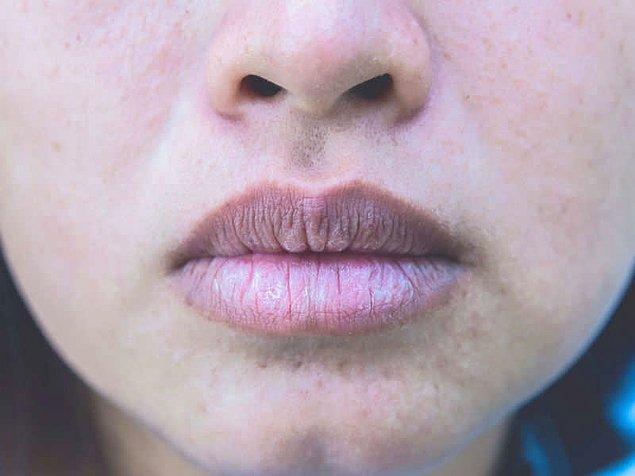 1. Soluk ve beyaz dudaklar