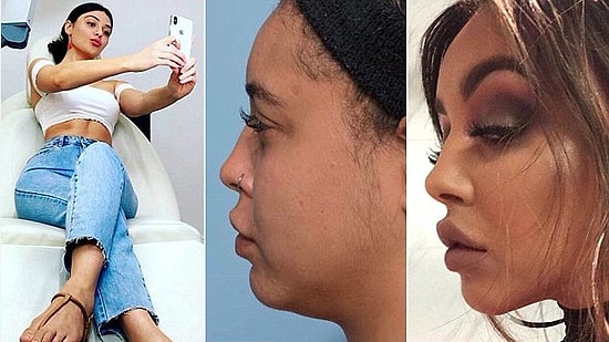 Güzellik Arzusu Nereye Gidiyor? Artık Moda Selfie'lerde İyi Görünmek İçin Estetik Yaptırmak