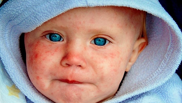 8. Корь невероятно заразна. Она передается воздушно-капельным путем и является одной из основных причин смерти среди детей раннего возраста.