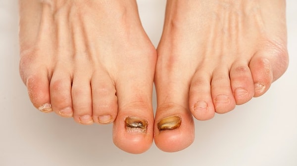 4. Уменьшится риск грибковых заболеваний