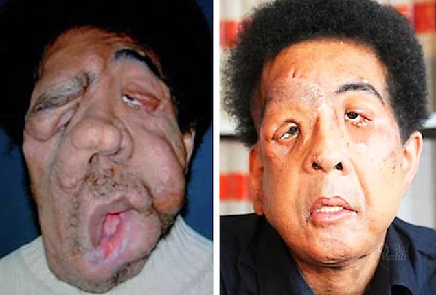 15. Rafael ile benzer şekilde fil hastalığından mustarip olan Pascal Coler.