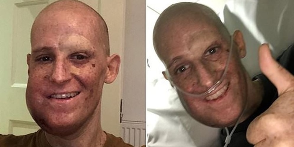 Bir Milyonda Bir Görülen Rahatsızlık Sebebiyle Hayatını Güneş Işığından Uzak Geçiren İş Adamı!