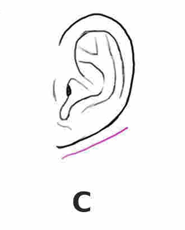 Крохотные мочки или уши практически без мочек: