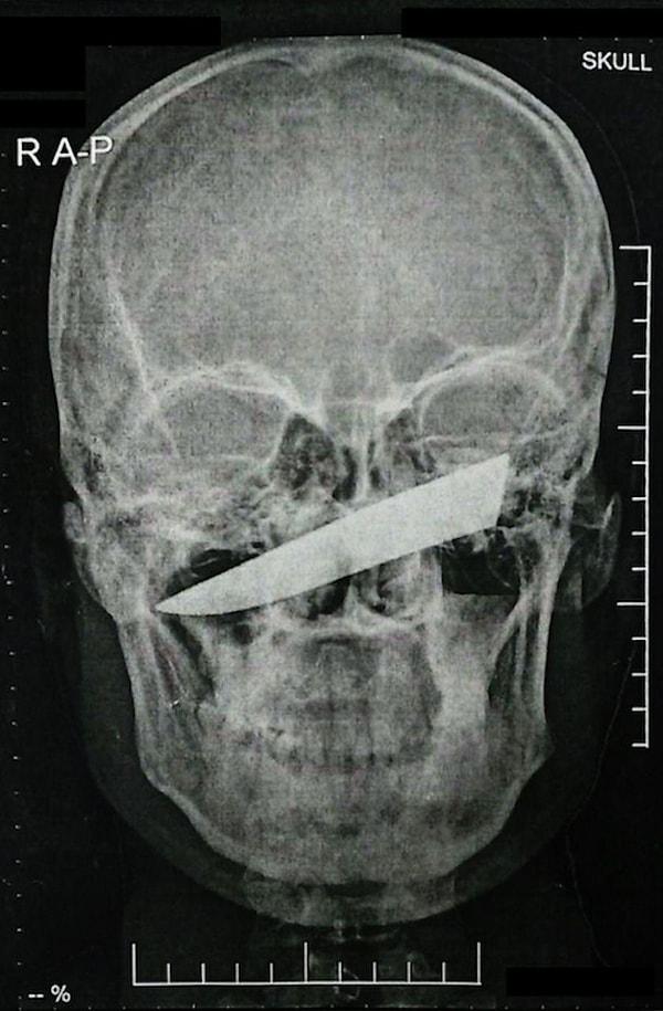 Sarhoşken ettiği kavgada gözünün altından bıçaklanan bir adamın, kafatasına giren 10 santimetrelik bıçağı çıkarmak için ameliyat olması gerekti.