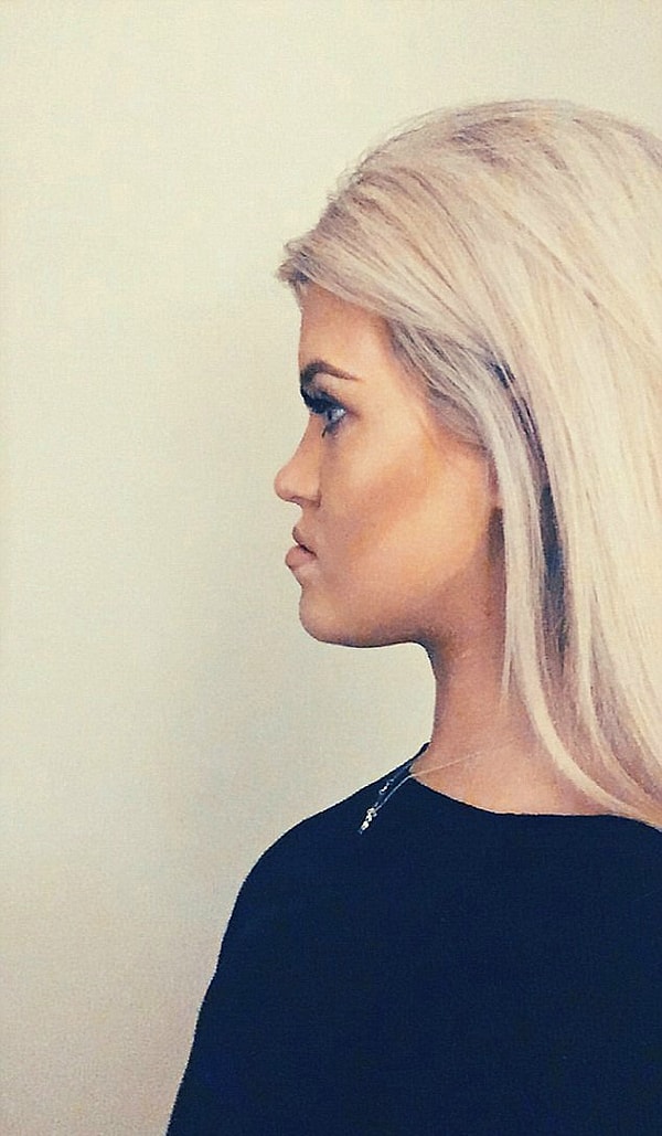 Девушка вспоминает, что помимо постоянных издевательств со стороны сверстников, она испытывала сложности с приемом пищи, т.к. зубы не смыкались