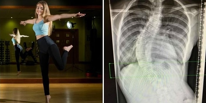 Başarının Engeli Olmaz: Doğuştan Omurga Eğriliği Olan Genç Kız Dansçı Olma Hayalini Gerçekleştirdi!