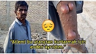 Tüm Vücudu Tümörle Kaplı Olduğu İçin Hayatı Zindan Olan Pakistanlı Adamın Yürek Burkan Hikayesi