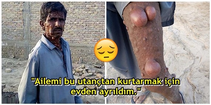 Tüm Vücudu Tümörle Kaplı Olduğu İçin Hayatı Zindan Olan Pakistanlı Adamın Yürek Burkan Hikayesi