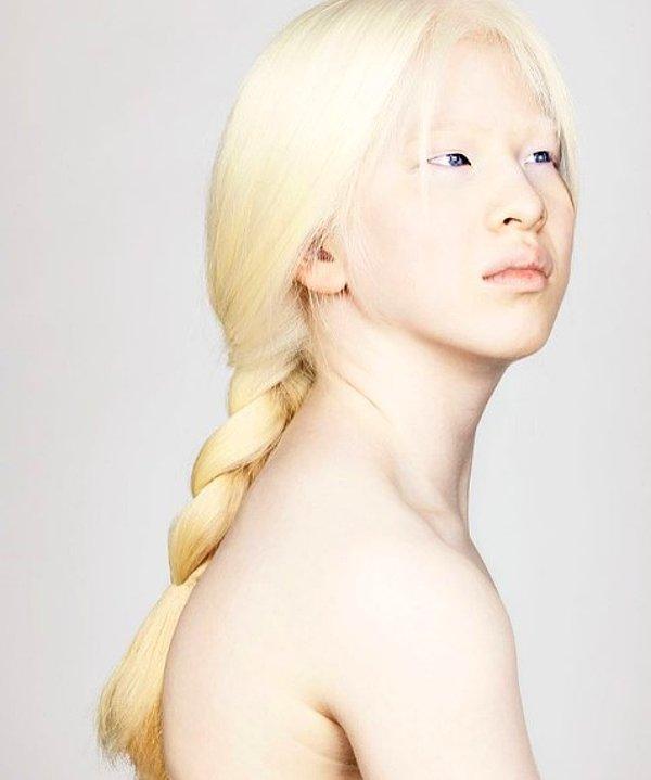 8. Xueli, 14 yaşında bir albino.