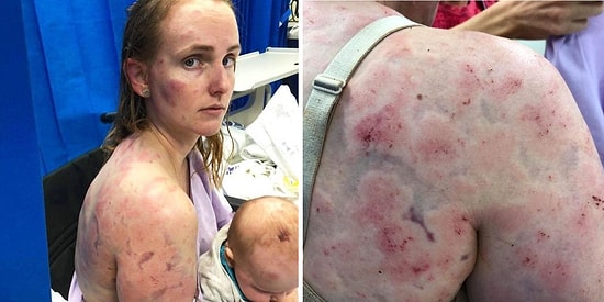 Мать закрыла собой ребенка, спасая от града размером с теннисный мяч