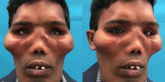 İnsanı Görme, Koklama ve Çiğneme Duyularından Mahrum Bırakan Aslan Surat Sendromundan Muzdarip Adam