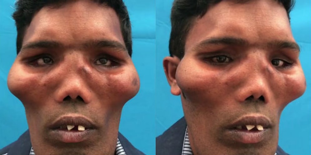 İnsanı Görme, Koklama ve Çiğneme Duyularından Mahrum Bırakan Aslan Surat Sendromundan Muzdarip Adam