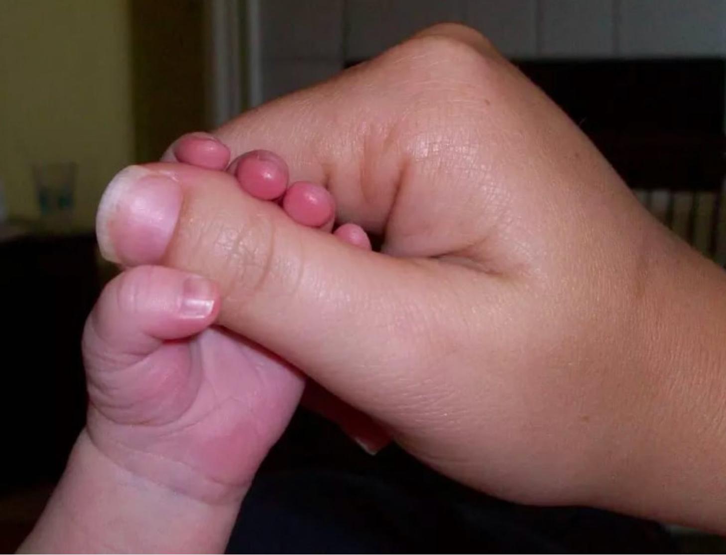 Пальцы становятся толще. Большие пальцы на руках широкие. Маленький ноготь на большом пальце. Широкий ноготь на большом пальце.