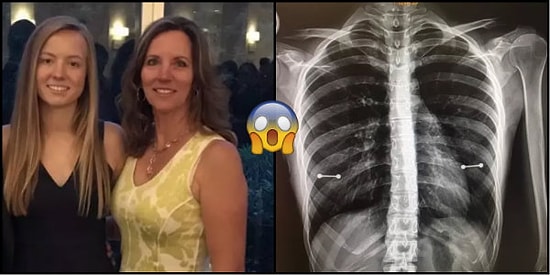 Vay Başına Gelenler! Kızının Meme Ucu Piercingi Olduğunu Röntgen Çekilirken Anlayan Anne