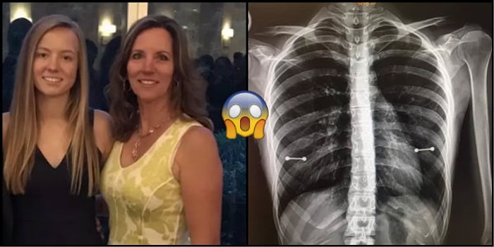 Vay Başına Gelenler! Kızının Meme Ucu Piercingi Olduğunu Röntgen Çekilirken Anlayan Anne