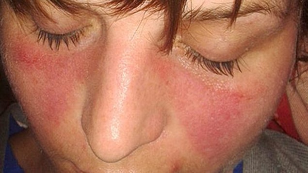 Lupus(SLE) ne sıklıkta görülür?