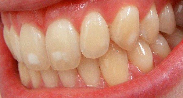 9. Dişlerde beyaz lekeler