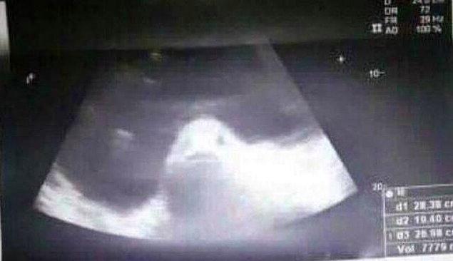 Over kistleri olan genç kadının ultrason görüntüleri herkesi şoke etti!
