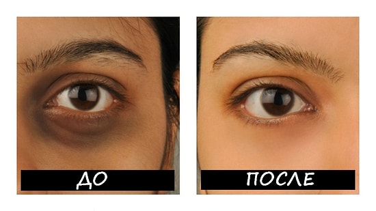 Как избавиться от мешков под глазами: 5 способов, к которым прибегают известные модели