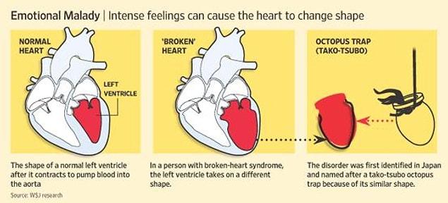 18. It is possible to die from a broken heart. It is called stress cardiomyopathy.