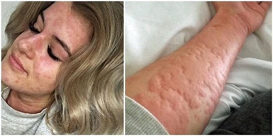 21-летняя девушка, страдающая аллергией на холод, может умереть в зимний период, если не найдет способ согреться