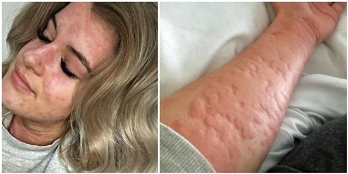 21-летняя девушка, страдающая аллергией на холод, может умереть в зимний период, если не найдет способ согреться