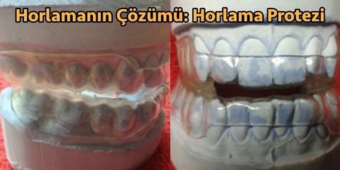 Horul Horul Horlamaya Son! Uyku Apnesi ve Horlama İçin Kesin Çözüm: Horlama Protezi