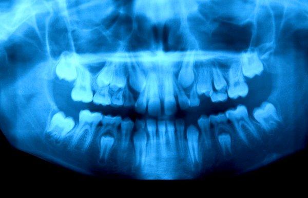 2. Süt dişleriyle kalıcı dişleri yer değiştiren 10 yaşındaki bir erkek çocuğunun çenesi:
