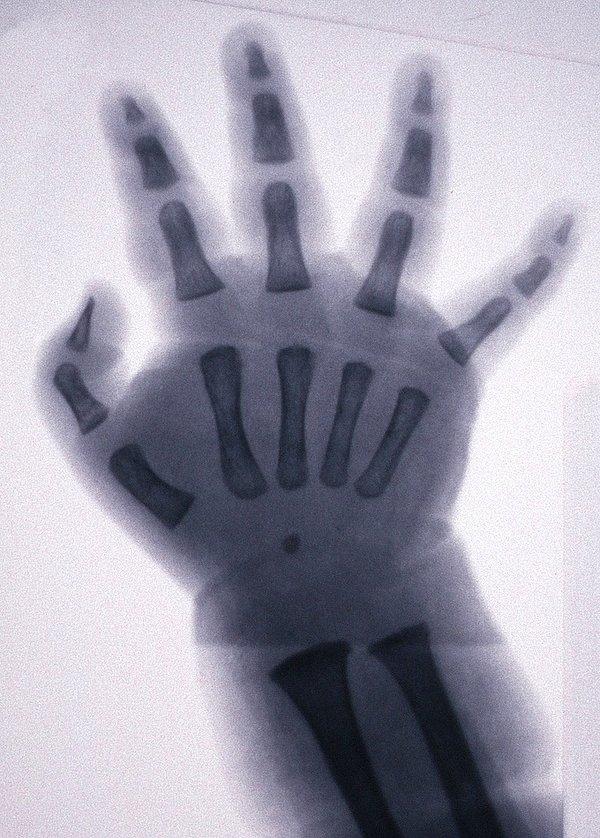 7. Yetişkinlerin aksine, belli bir yaşa kadar kemik yerine kıkırdakları olan bir çocuk elinin röntgeni: