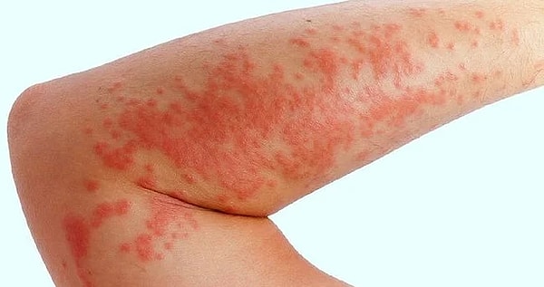 13. Экзема передается половым путем?