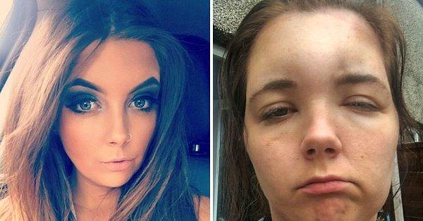 26 yaşındaki eğitimli kuaför Charlotte Cragg alerji testlerinin ne kadar önemli olduğunu acı bir yolla öğrenmek zorunda kaldı.