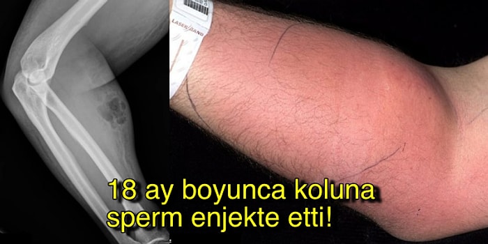 Her Derde Deva Olduğunu Düşündüğü İçin 18 Ay Boyunca Kendisine Sperm Enjekte Eden Adam!