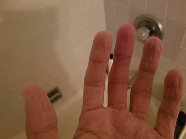 17. Палец с поврежденным нервом не морщится после ванны