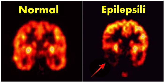 Nöbetleri Adeta Bir Ölüm Deneyimi Olan Epilepsi Hastalığı ve Epilepsi Nöbetleri Hakkında Bilmeniz Gerekenler