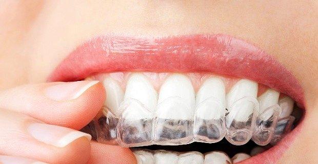 telsiz diş düzeltme 