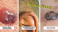 Cilt Kanseri Belirtileri ve Korunma Yöntemleri ile İlgili En Çok Merak Edilen Soru ve Cevaplar