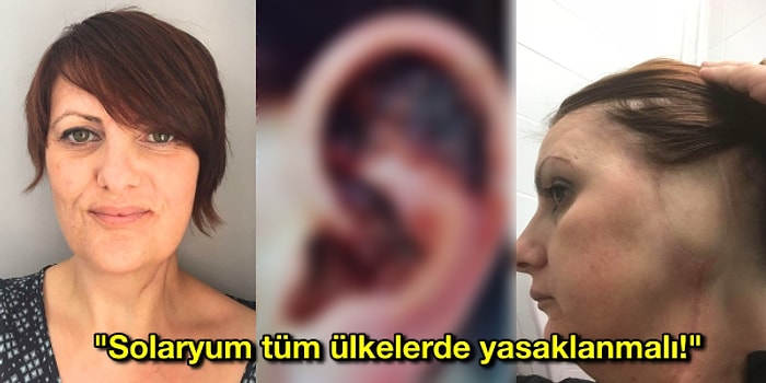 Her Şey Güzellik İçin! Bronz Ten Uğruna Yıllardır Gittiği Solaryum Yüzünden Kulağı Kesilen Kadın