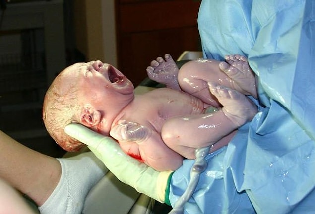 18. Perinatal Komplikasyonlar